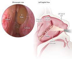 nasal_polyp