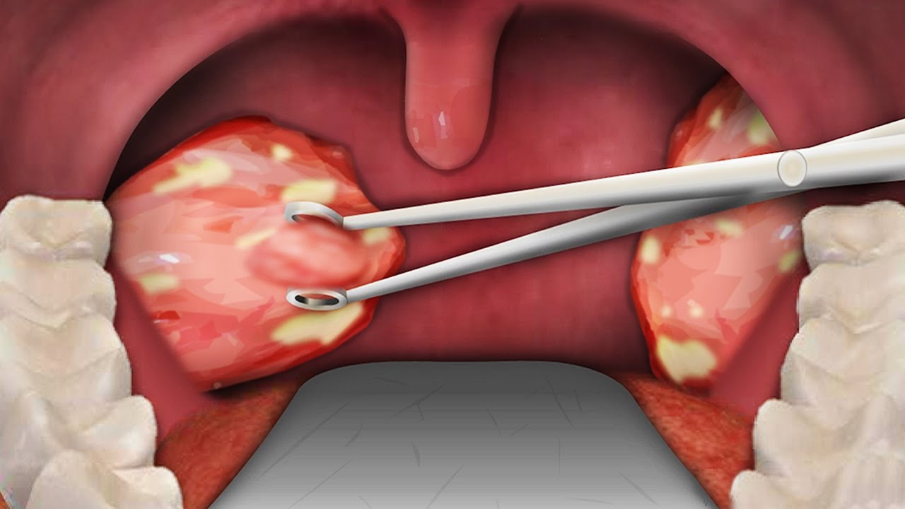 tonsillectomy